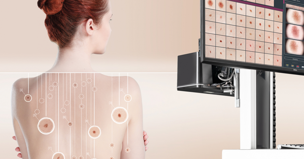 Acest AI detectează cancerul de piele și salvează vieți