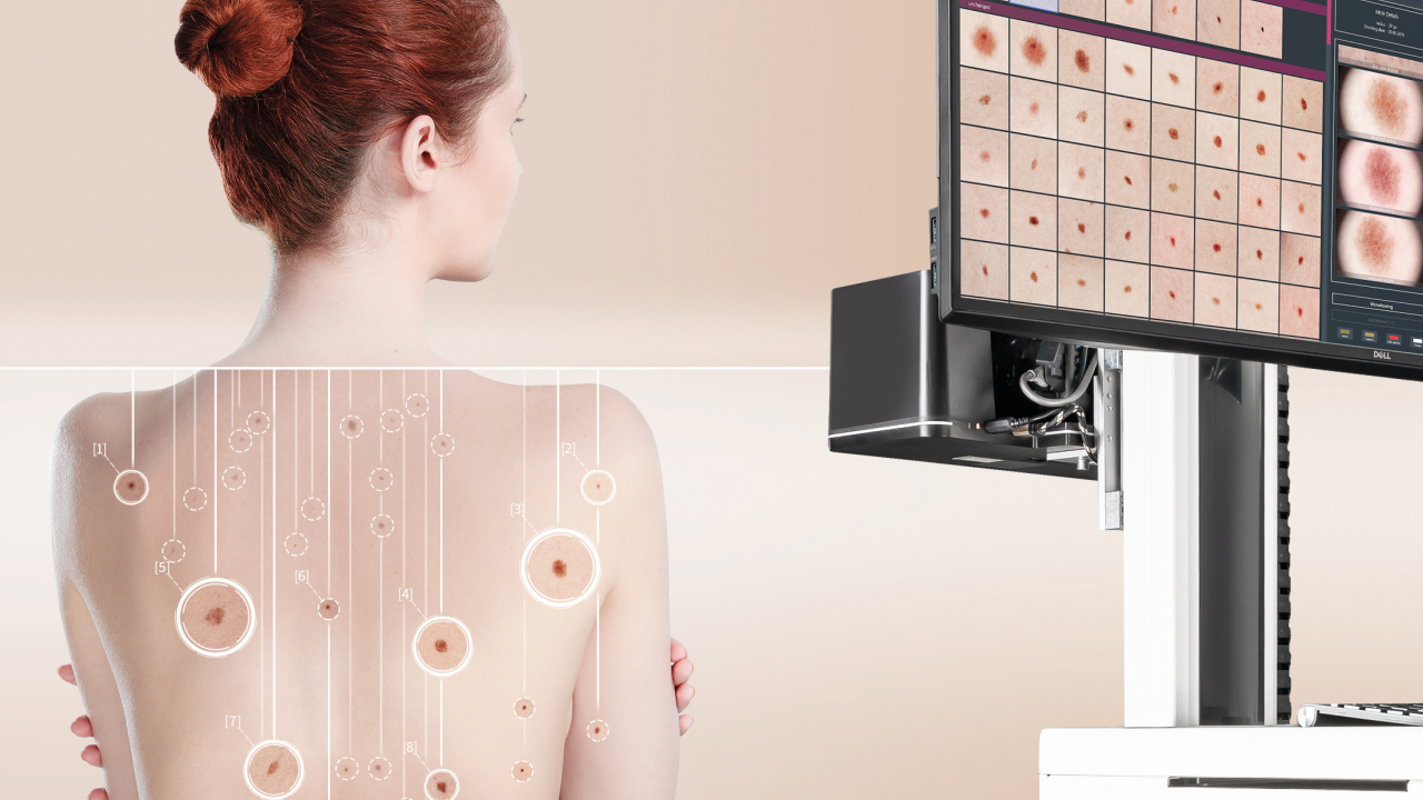 Acest AI detectează cancerul de piele și salvează vieți