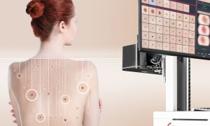 Acest AI detectează cancerul de piele și salvează vieți