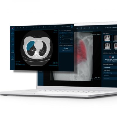 Romanian medtech startup XVision gets € 1 million in a new round of funding
